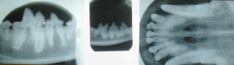 A picture of teeth in the same position as they are on.